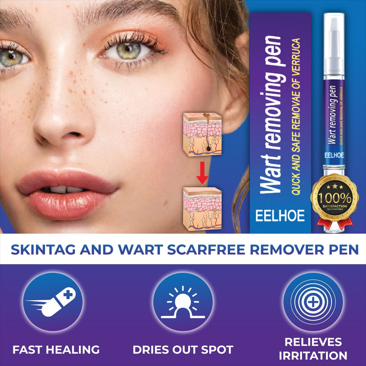 EELHOE Wart Removal Pen